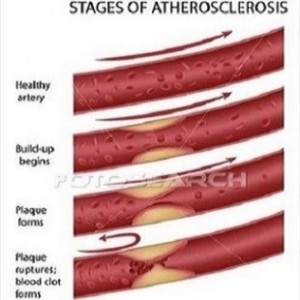 atherosclerosis-eps8_~k6574897[1]